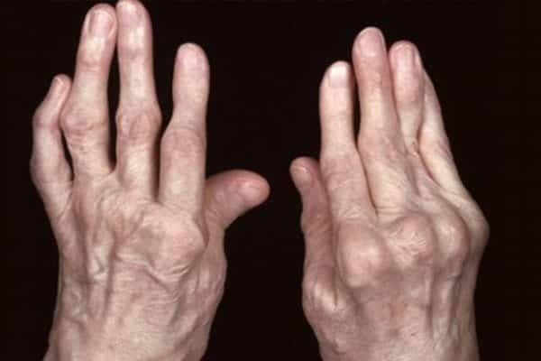 Bàn tay bị biến dạng khi bị viêm khớp dạng thấp