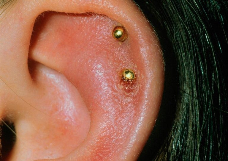 Xỏ lỗ tai không đảm bảo vô trùng có thể gây viêm sụn vành tai