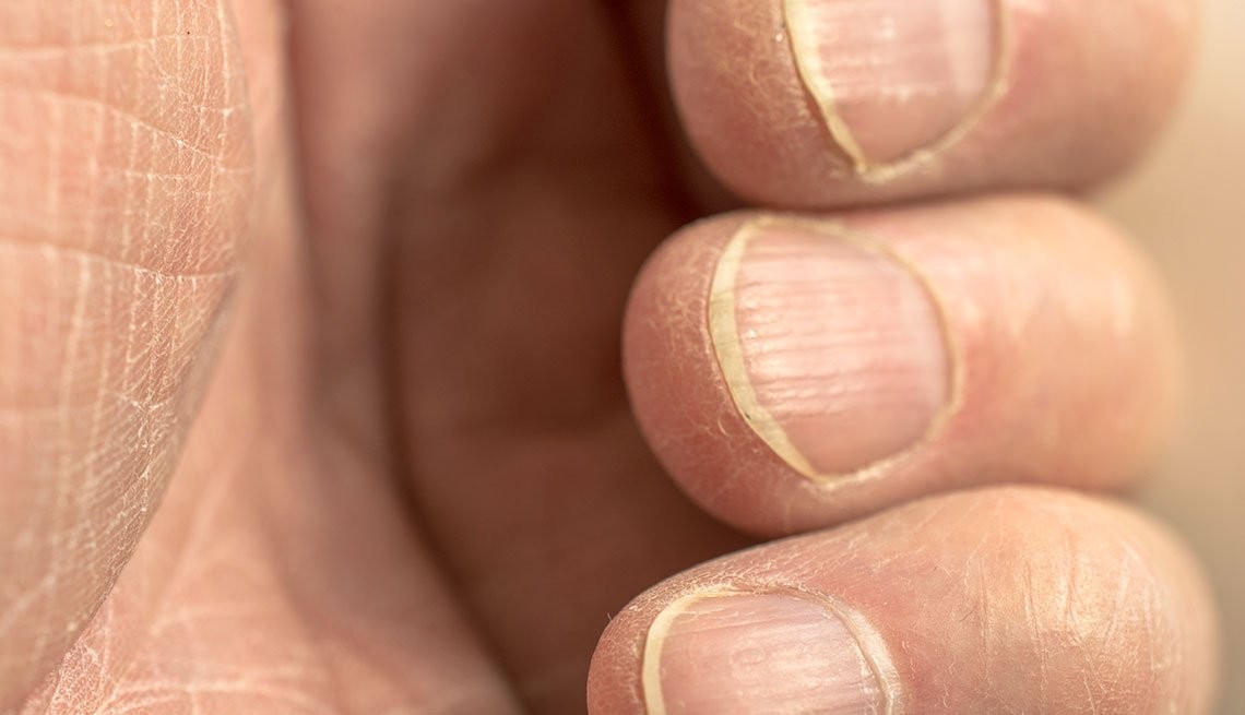 10 dấu hiệu móng tay bất thường cảnh báo sức khỏe