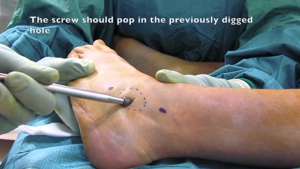 Hình ảnh mô phỏng phẫu thuật một trường hợp bàn chân bẹt
