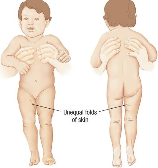 Nếp lằn mông và chiều dài hai chân không đều nhau ở trẻ trật khớp háng bẩm sinh