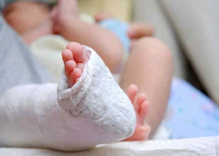 Bó bột chỉnh hình chỉ định cho trẻ trật khớp háng bẩm sinh dưới 6 tháng tuổi.