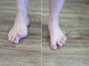 Hình ảnh minh họa bài tập nâng ngón chân cho bàn chân bẹt