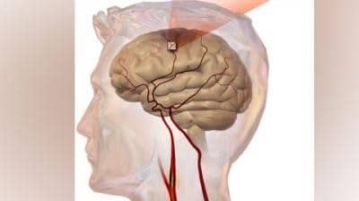 Cơn thiếu máu não thoáng qua là gì?