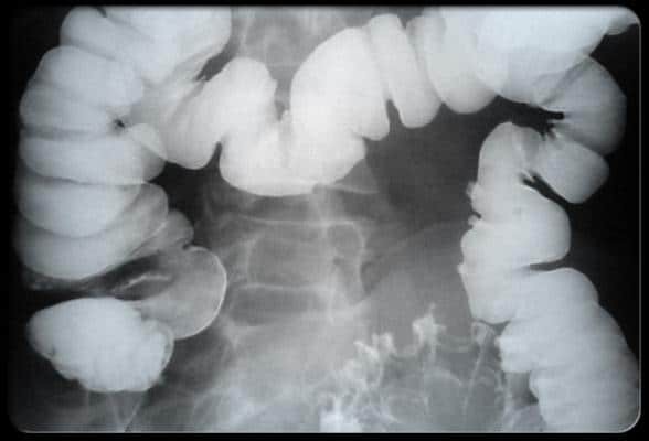Hình ảnh đại tràng trên phim X quang.