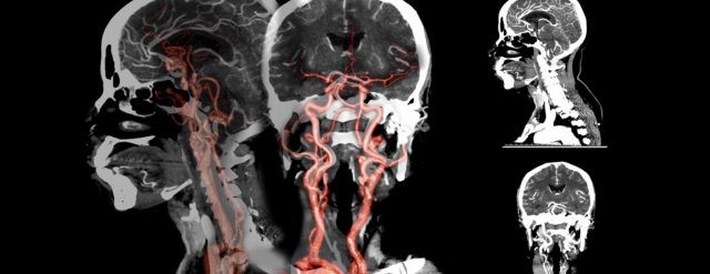Phim chụp CT dựng hình mạch máu não