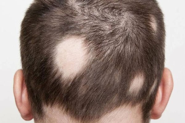 Tóc rụng nhiều có thể dẫn đến hói
