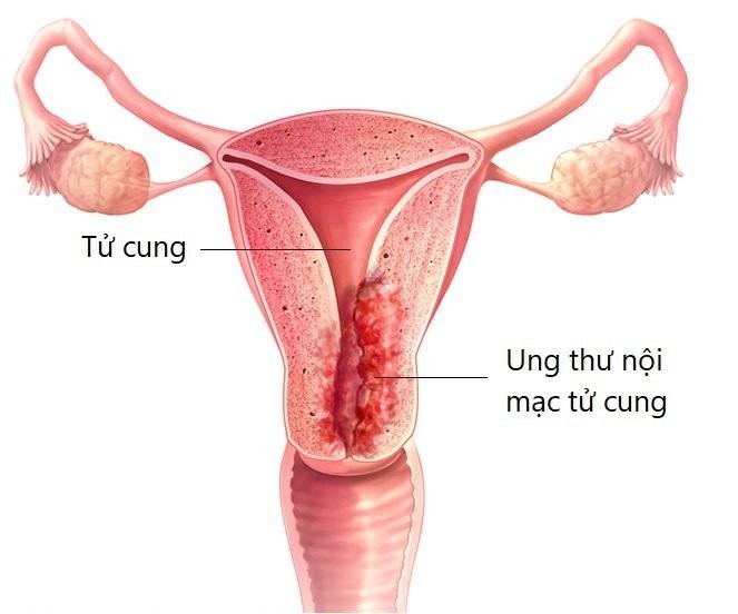 Ung thư nội mạc tử cung là ung thư của lớp tế bào lót