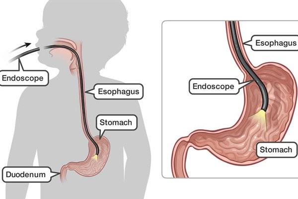 Nội soi thường được dùng để quan sát tổn thương và sinh thiết (endoscope: ống nội soi/esophagus: thực quản/stomach: dạ dày)