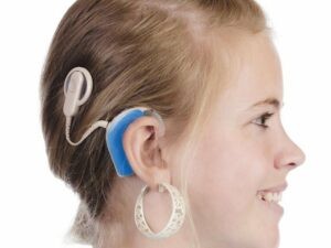 Cấy ốc tai điện tử là một giải pháp cho bệnh nhân điếc