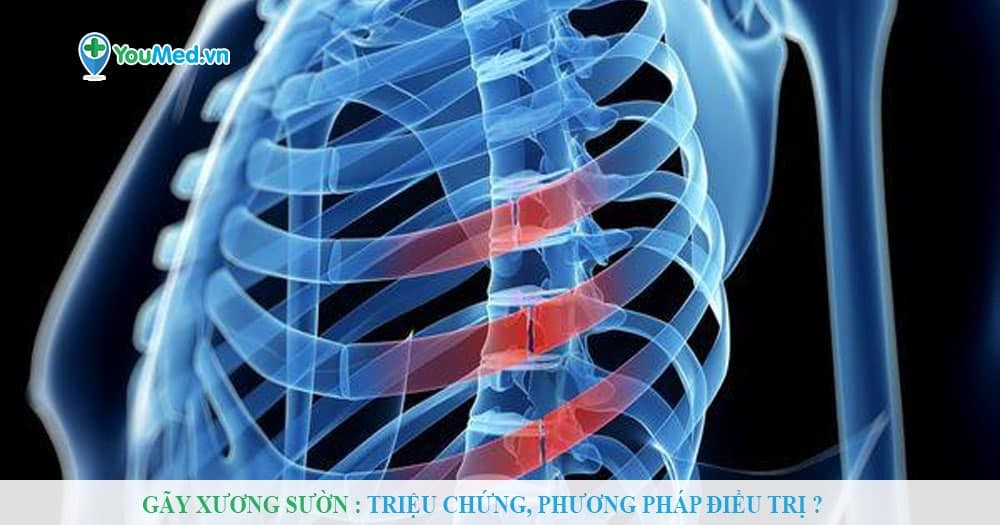 Gãy xương sườn: dấu hiệu nhận biết và phương pháp điều trị