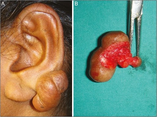 cách chữa sẹo lồi tai