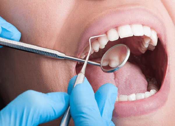 Cách phòng ngừa áp xe răng