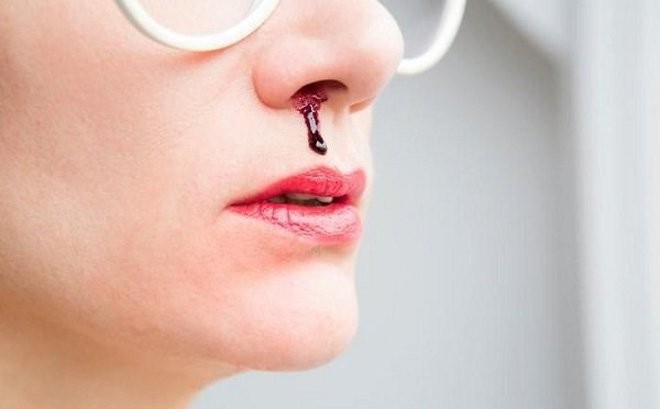 Chảy máu cam là một trong những triệu chứng của bệnh lao mũi