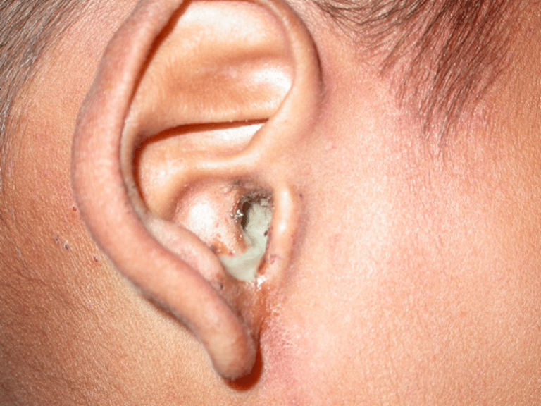 Dịch mủ chảy ra từ tai là một dấu hiệu bệnh lý
