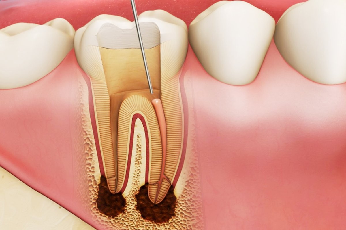 Cách điều trị áp xe răng