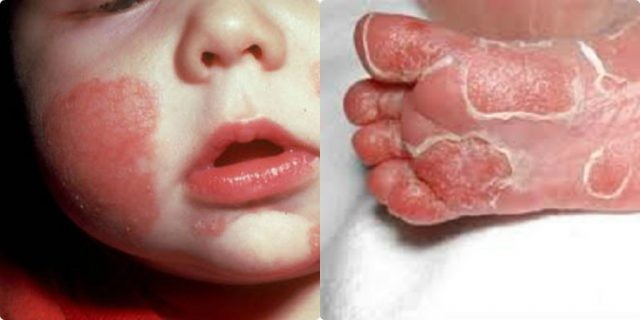 di truyền biểu hiện giống như tình trạng viêm mũi cấp ở trẻ nhỏ.
