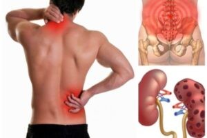 Đau vùng hông lưng là triệu chứng thường gặp của bệnh nhiễm trùng thận