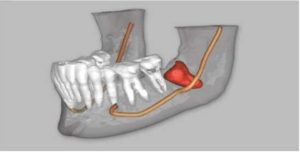 Phần mềm chẩn đoán mô phỏng chính xác tương quan giữa răng và dây thần kinh xương ổ răng hàm dưới
