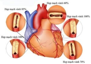 Chụp động mạch vành : Có nguy hiểm không?