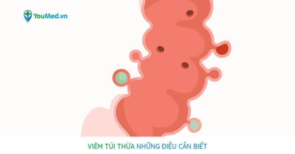 Viêm túi thừa: Những điều cần biết