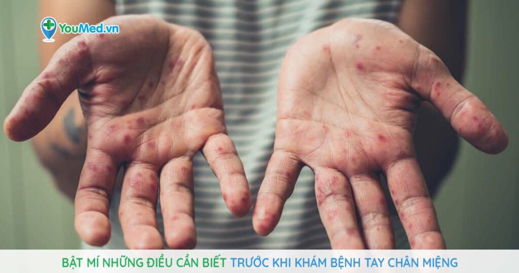Bật mí những điều cần biết trước khi khám bệnh Tay Chân Miệng