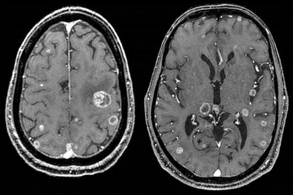 Hình ảnh ung thư não trên CT Scan