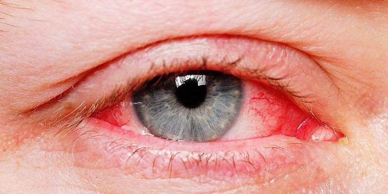 Liên hệ ngay cho bác sĩ nếu xảy ra tình trạng mắt sưng đỏ khi dùng thuốc