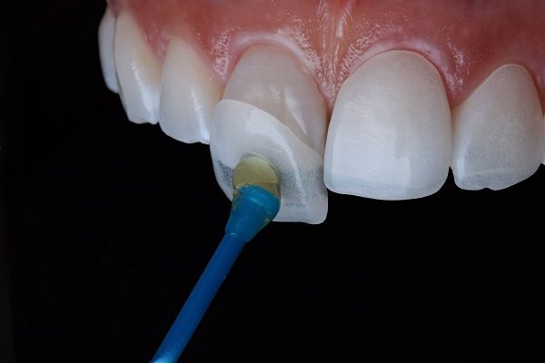 Mặt dán sứ veneer