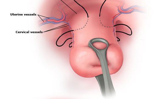 Khâu eo tử cung: Phương pháp, chỉ định, chăm sóc sau khâu - YouMed