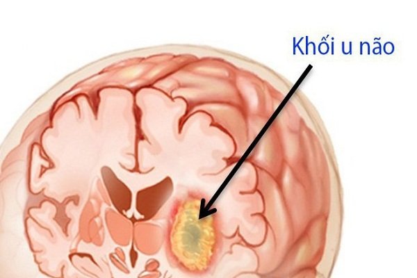 Ung thư não thứ phát