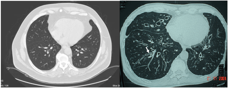 CT scan phổi bình thường và CT scan phổi có giãn phế quản