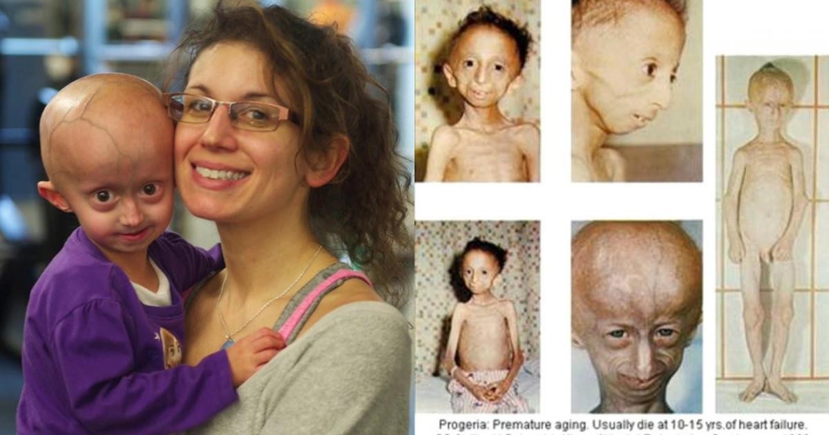 trẻ em bị hội chứng Progeria