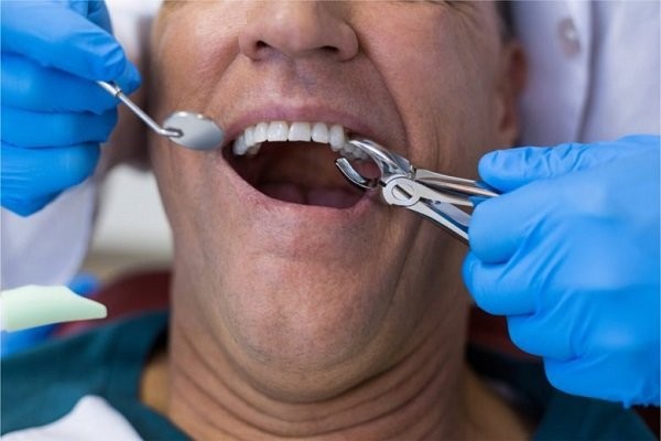 Chăm sóc sau nhổ răng như thế nào để lành thương tốt ?