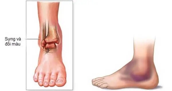 Vùng cổ chân đau dữ dội, sưng, bầm tím có thể là triệu chứng của gãy xương mắt cá chân