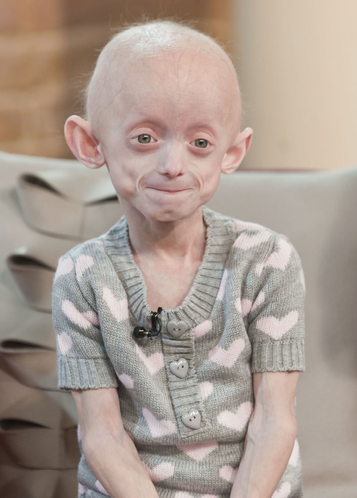 Hội chứng Progeria khiến trẻ già