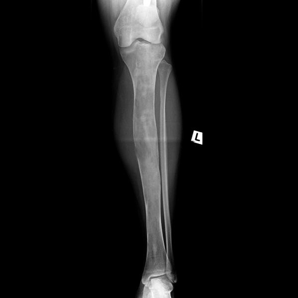 Hình ảnh X-quang loạn sản xơ xương ở xương chày