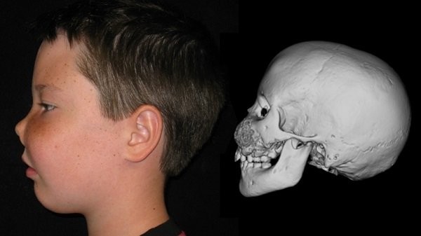 Biến dạng loạn sản xơ xương vùng sọ mặt