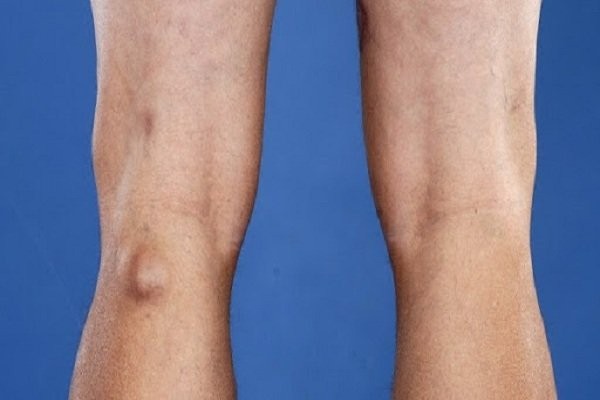 Nang hoạt dịch vùng khoeo chân không bao giờ ung thư hóa