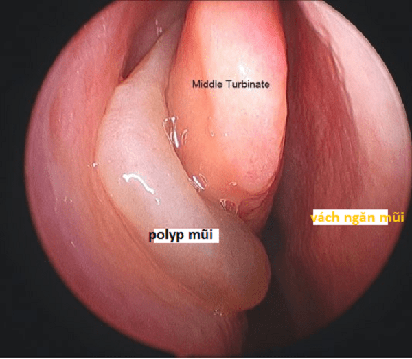 Hình ảnh polyp mũi qua nội soi