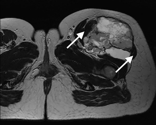 Hình ảnh sarcoma mô mềm trên phim chụp cộng hưởng từ (MRI)