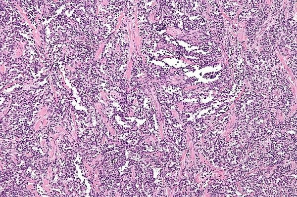 Hình ảnh của sarcoma cơ vân (Rhabdomyoarcoma) dưới kính hiển vi