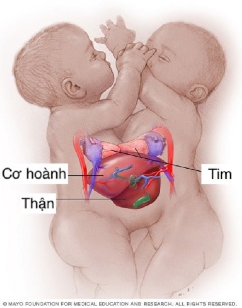 2 bé có chung cơ hoành và gan nhưng tim tách biệt