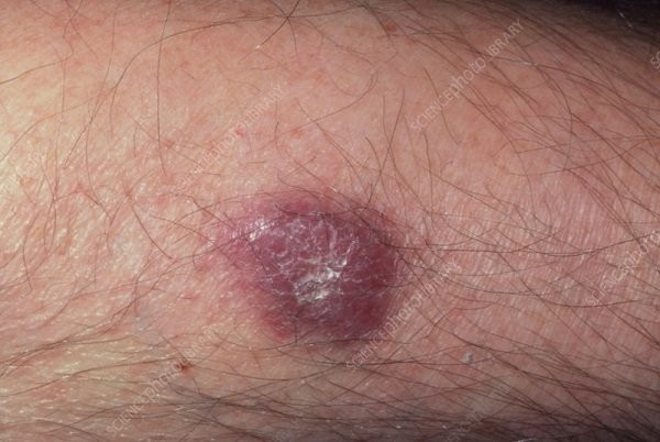 Tổn thương ở da thường gặp trong ung thư Kaposi