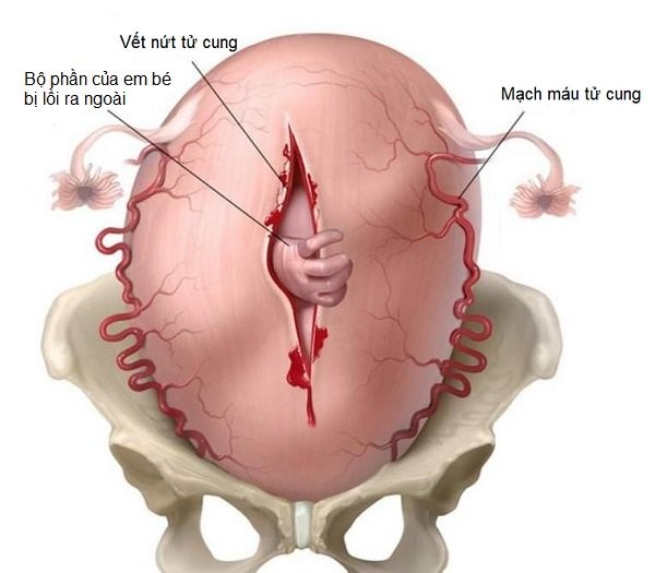 Vỡ tử cung là tình trạng bị nứt và rách hoàn toàn các lớp cơ ở tử cung