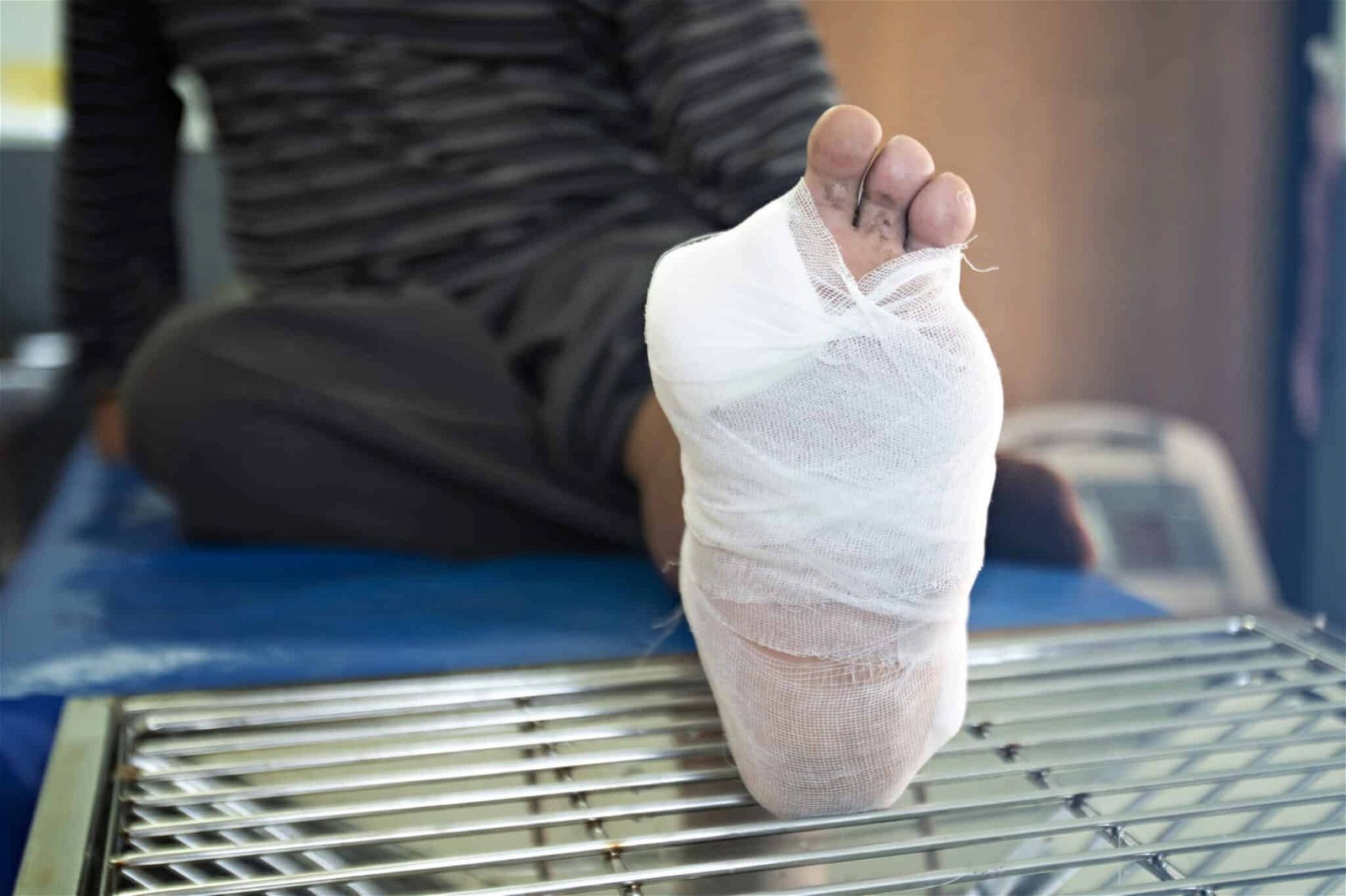 Đoạn chi do vết loét bàn chân đã bị nhiễm trùng nặng ở bệnh nhân tiểu đường