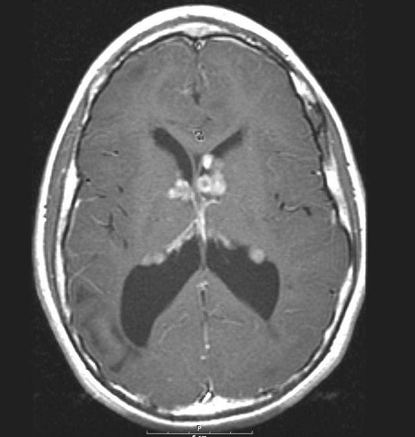 Hình ảnh MRI tổn thương não ở bệnh nhân xơ cứng củ