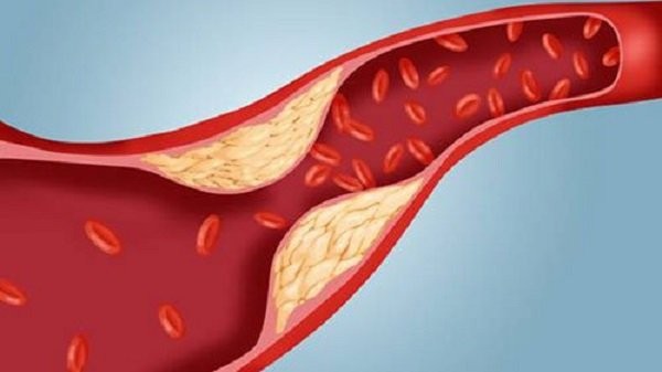 Xơ vữa mạch máu làm tăng nguy cơ huyết khối