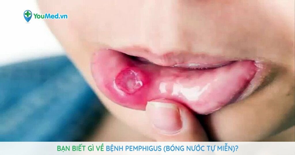 Bạn biết gì về bệnh pemphigus (bóng nước tự miễn)?