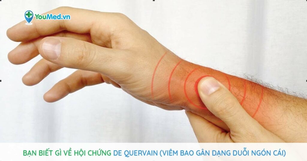 Hội chứng De Quervain (Viêm bao gân dạng duỗi ngón cái): Bạn đã biết gì?